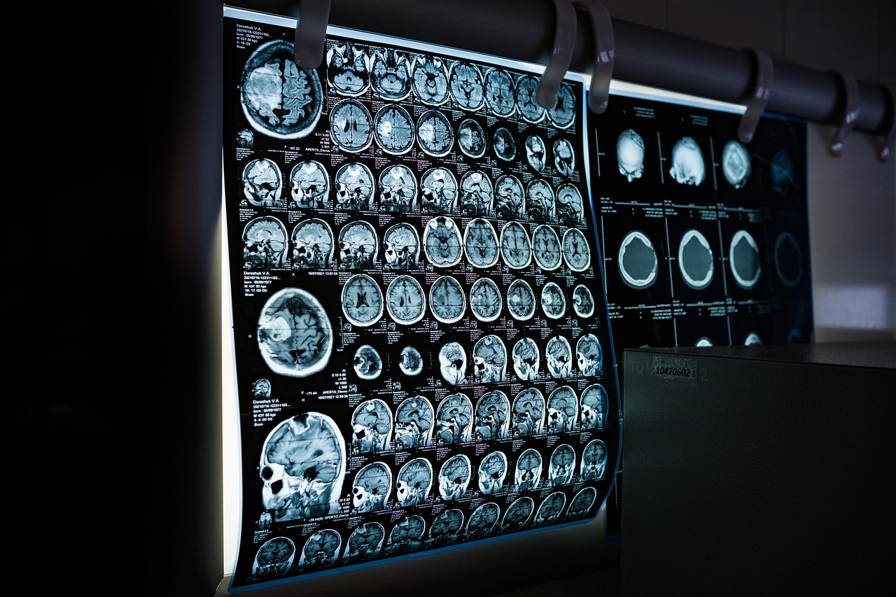 Radiologist reviewing CT and MRI scans on computer monitors using AI-assisted diagnostic tools